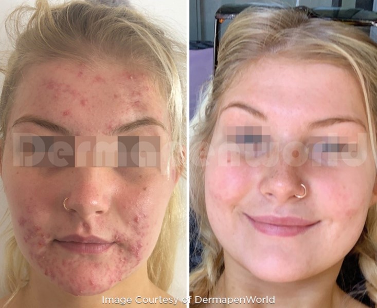 Dermapen - Medi Derma